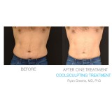 Coolsculpting Before and After Image