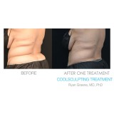 Coolsculpting Before and After Image