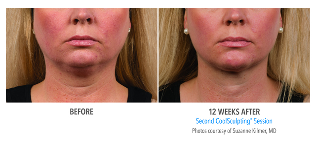 Chin Coolsculpting Before and After