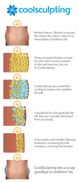 How does Coolsculpting Work Image